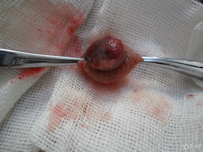 猜☆图☆病☆例☆(43)答案:化脓性肉芽肿,前5名回答