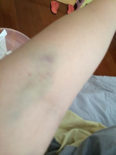 抽血过后胳膊会不会有青一块紫一块的而且一天比一天紫,抽完一晚上都