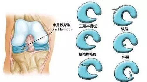 (膝盖半月板损伤)