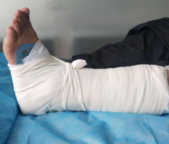 只是崴个脚,你给我打石膏干什么?