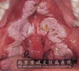 性病隐性梅毒出现的原因