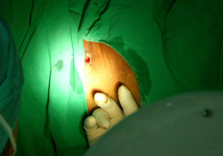 [病案讨论] 诊断不明确的"肛瘘".非常少见.