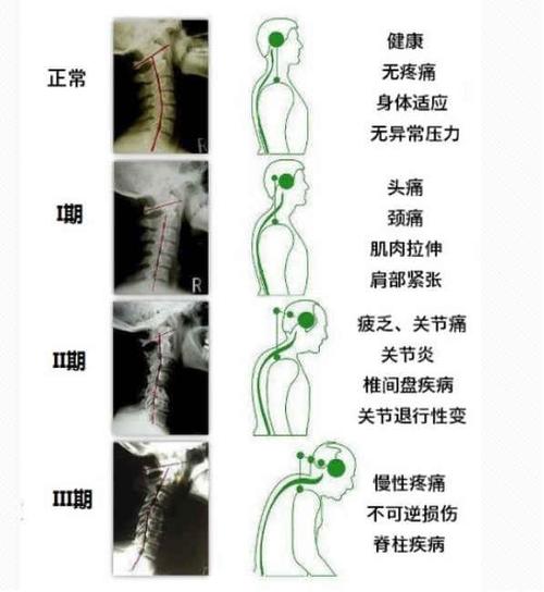 颈椎不适也是失眠的原因之一