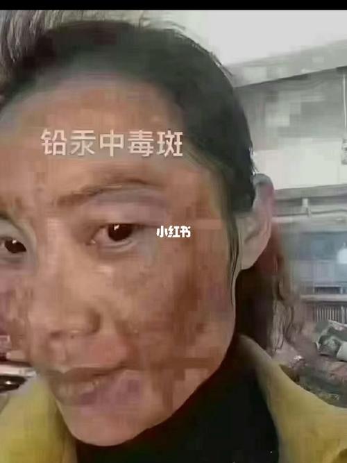 现在流行一种斑———叫网购斑 严重的铅汞中毒斑!