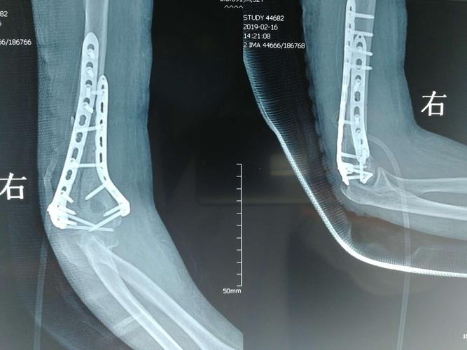 右肱骨干及髁间骨折切复内固定术