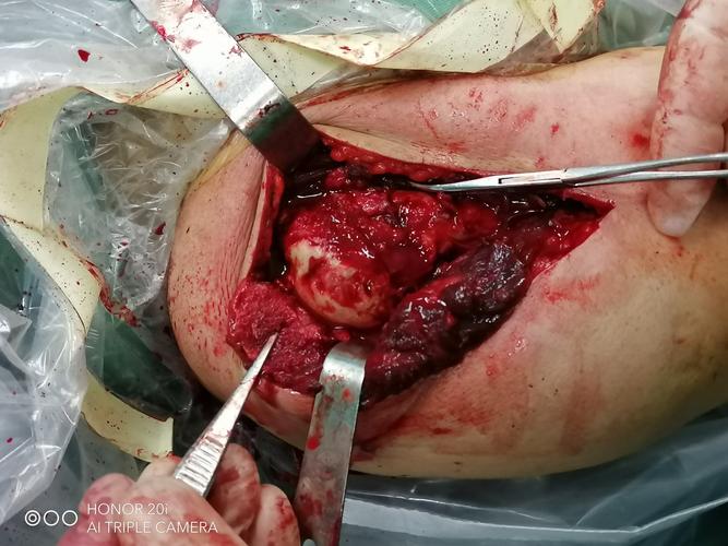 肱骨近端骨折术后肱骨大结节畸形愈合关节镜治疗