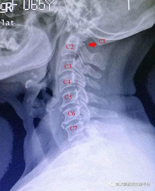 被误诊为颈椎病的寰枕融合