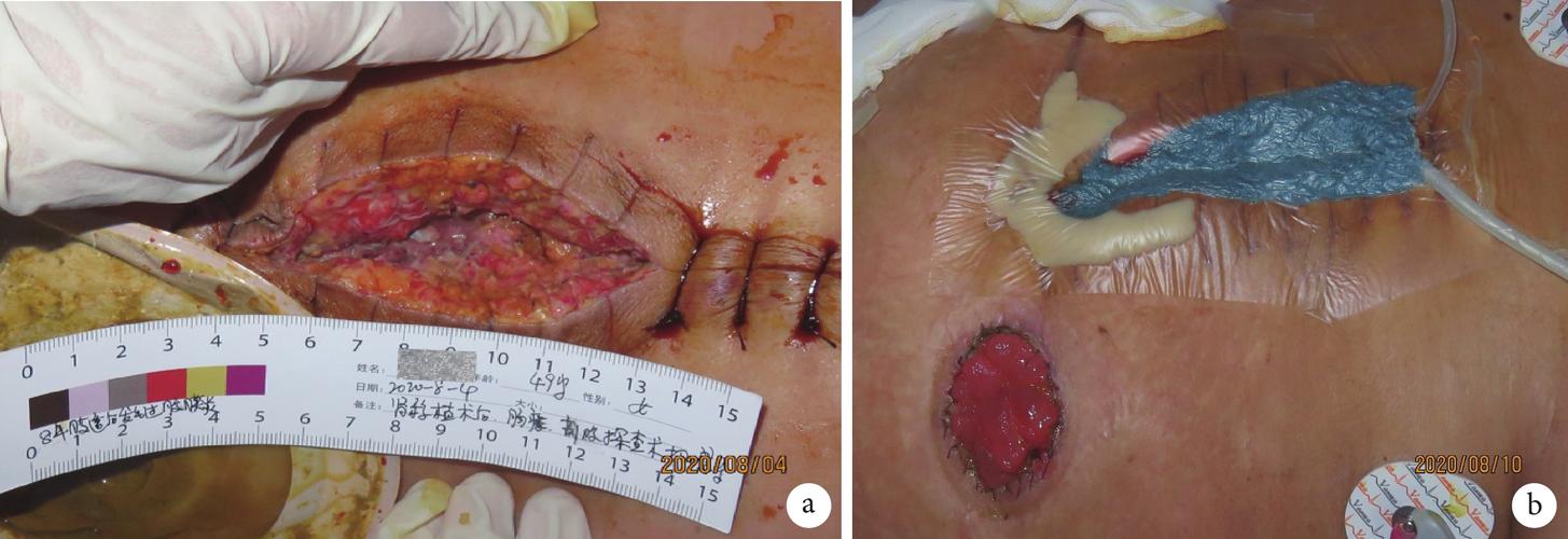 医护合作处理肾移植术后造口旁复杂伤口一例