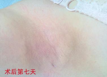 【腋臭】纳米微创汗腺清除术:一次祛除,不留疤痕