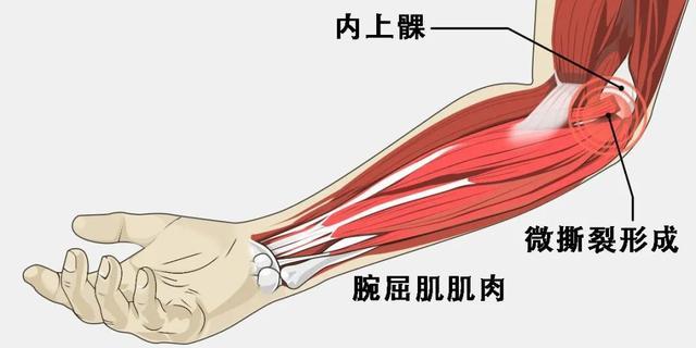 肘肌腱炎 肘滑囊炎