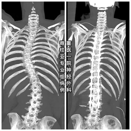 病例分享|成人脊柱侧弯畸形一例|腰椎|侧凸|矫形术