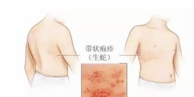 疱疹|水痘|病毒|带状|神经痛_网易订阅