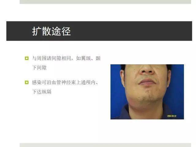 口腔颌面部间隙感染多图