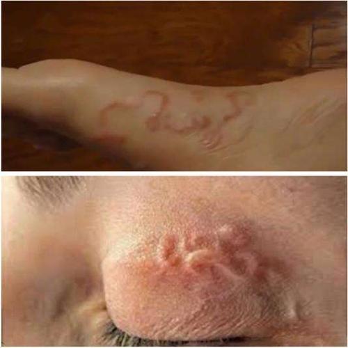 让人害怕!世界上五大种对人体最不利的寄生虫