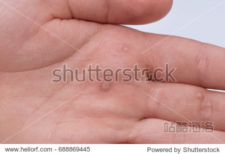 common wart ( verruca vulgaris ) a flat wart commonly found on