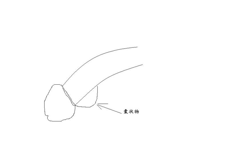 10天后纱布完全拿去,但在无碰撞的情况下, 阴茎下靠近冠状沟处为何会
