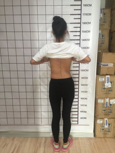 脊柱侧弯二女孩一男孩本周五的后续康复(之一)