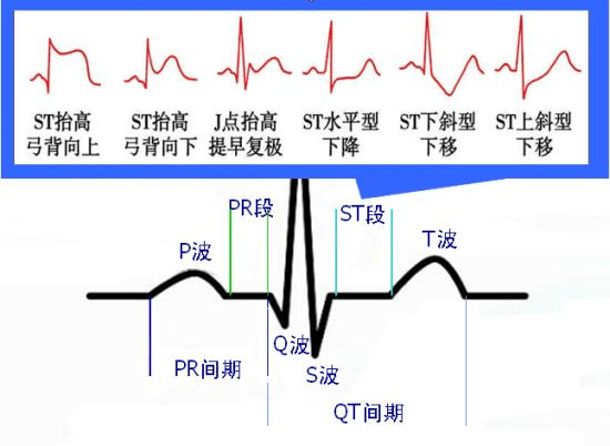 临床常见心电图汇总