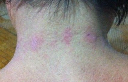 进来看看脖子后面起了一些红斑是什么症状