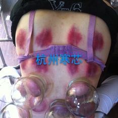 杭州寒芯中医揪痧个人动态 - 杭州寒芯中医揪痧直播间