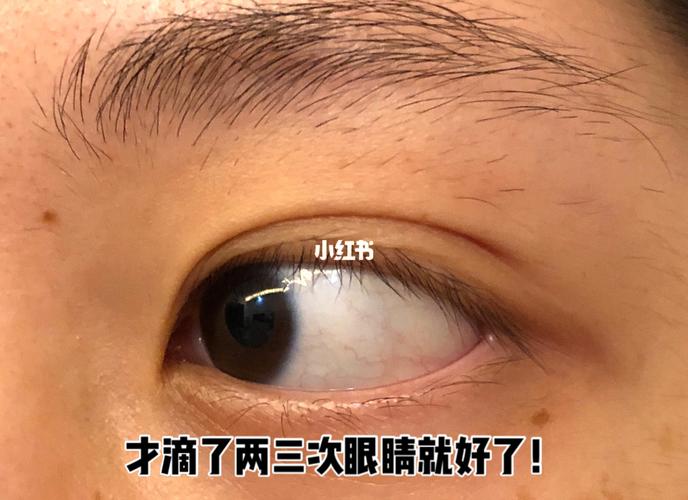 过敏性结膜炎眼睛爆血丝_结膜炎_眼药水_广州市番禺区