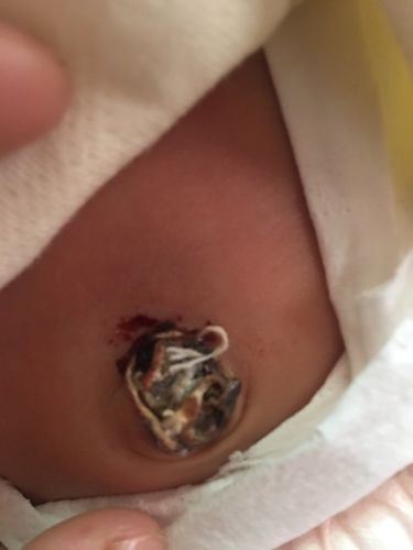 宝宝这肚脐眼应该没事吧!