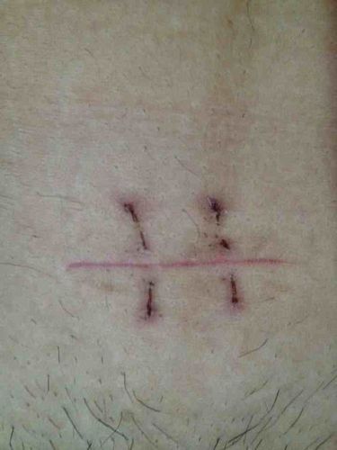 这是一位妈妈结扎后的手术刀口