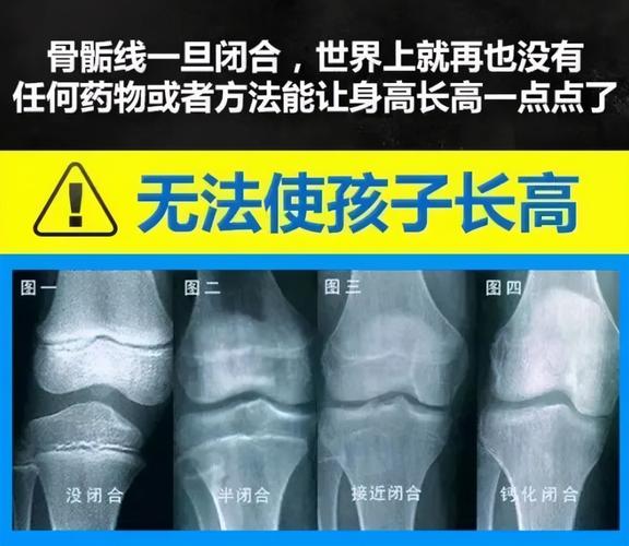 孩子长高有3个黄金期,矮小门诊教授:骨骺线未闭合前,有机会!
