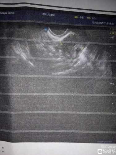 今天做阴超,说我子宫内膜不均匀,有薄有厚.