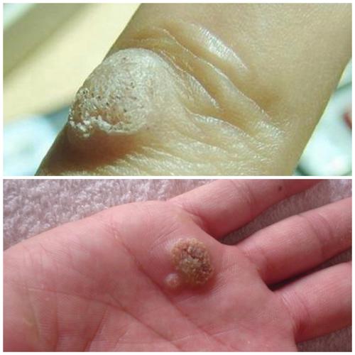 病毒性皮肤病——疣