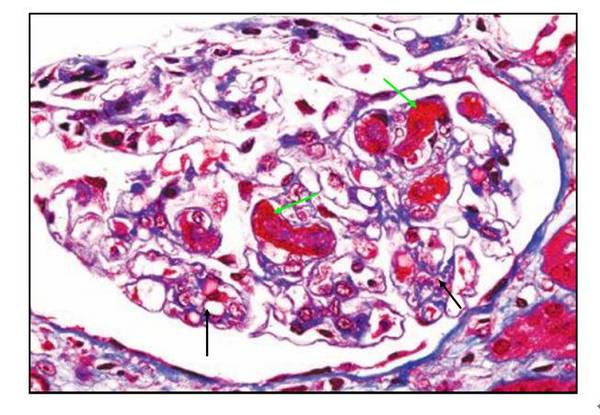 肾内病理图解:血栓性微血管病