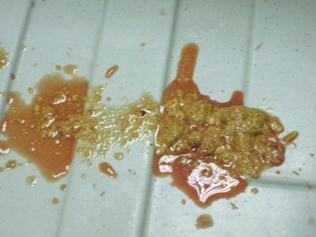 滴虫的感染症状