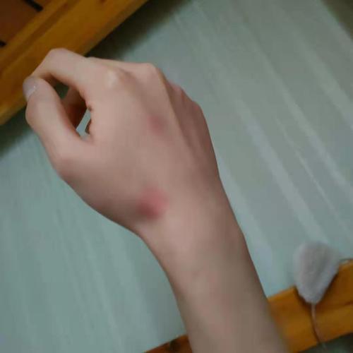 被男朋友打到满手臂淤青,报警有用么