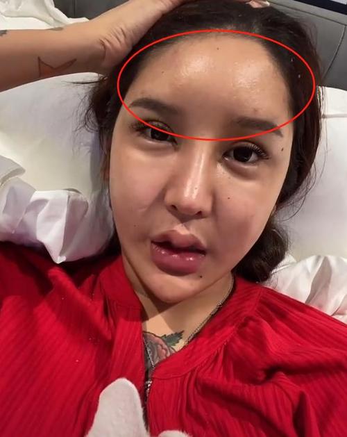 女网红晒整容失败视频,眼睛睁不开,嘴肿成"嘟嘟唇"