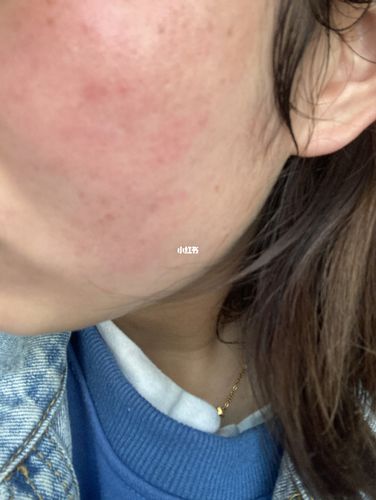 脸部过敏_过敏_洗面奶_药膏_干敏皮_护肤品_美妆_护肤