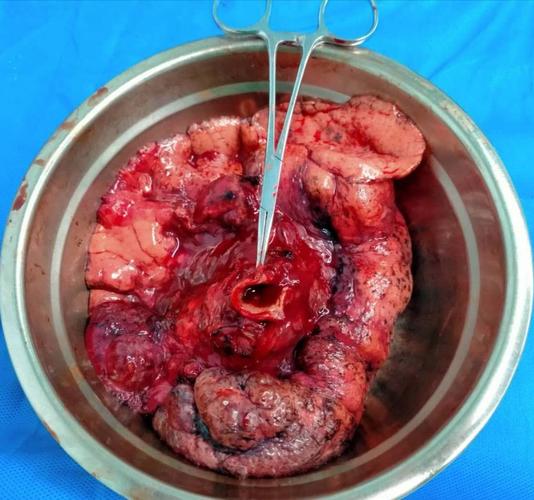 海南省中医院第一例左全肺切除术