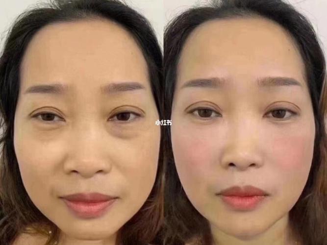 内切祛眼袋手术堪比换头