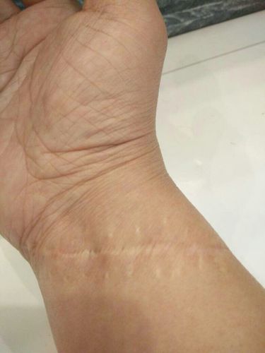 割过腕,手上留一个疤,别人看到,说这个人自杀过……会怎么办