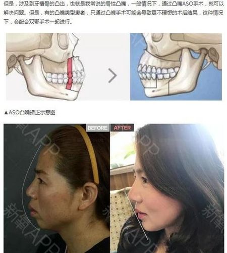 牙槽骨突出嘴突图片