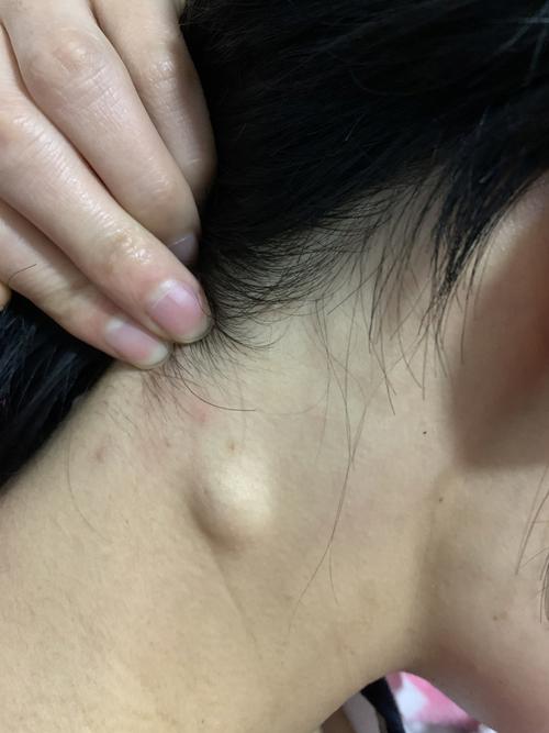 求助～皮下囊肿_皮肤问题_医疗健康_医疗健康其他