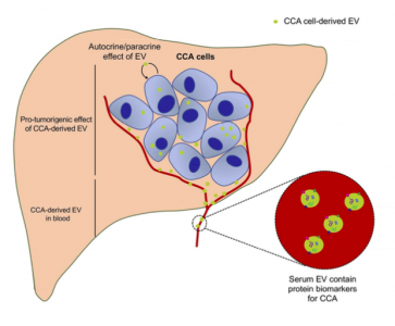 原发性硬化性胆管炎(primary sclerosing cholangitis,psc)等一些病因