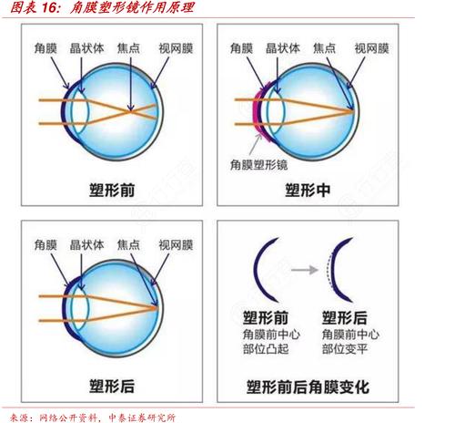 角膜塑形镜作用原理