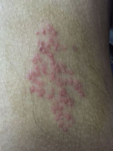 一觉醒来,不知道怎么搞的,大腿内侧这里起了红点点,刚开始只是痒,后来