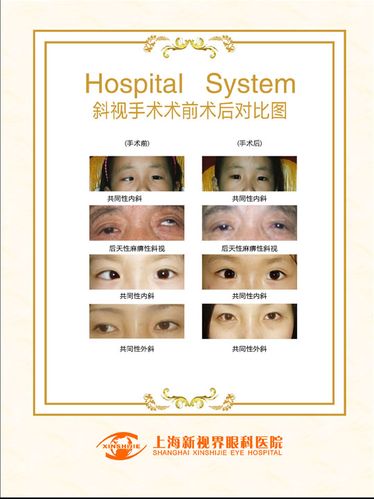 海报印制668素材256眼科医院斜视手术前后对比图