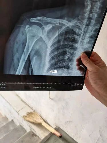 锁骨骨折?_医疗健康_医疗健康其他