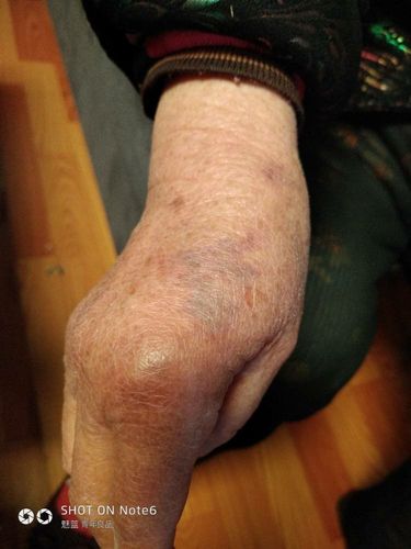 老年人手背紫红色淤血,平时吃的有复方血栓通胶囊,硝酸异山梨酯片,倍