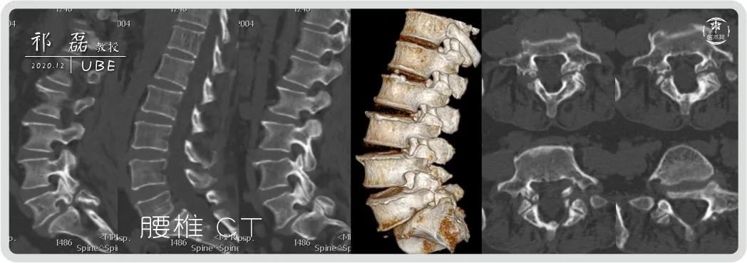 山东大学齐鲁医院祁磊教授行机器人辅助下ube内镜腰椎