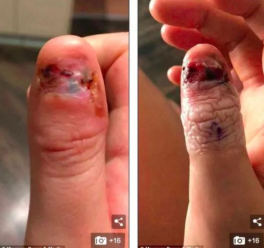 震惊!澳95后美女因为咬指甲患上癌症,被迫截肢,吓得浑身发抖!