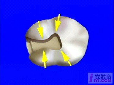 龋齿二类洞精典图片