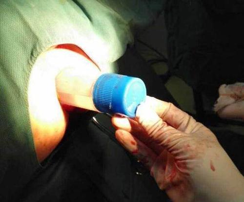 男子肛门夜晚被插15厘米胶水瓶3名医生忙了40分钟才取出来